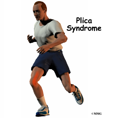 Plica Syndrome