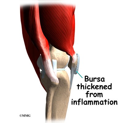 inflammation around knee cap