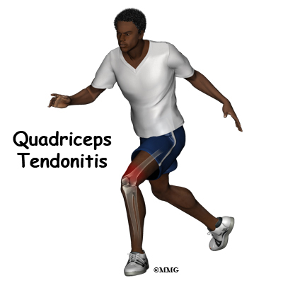 Quadriceps Tendonitis