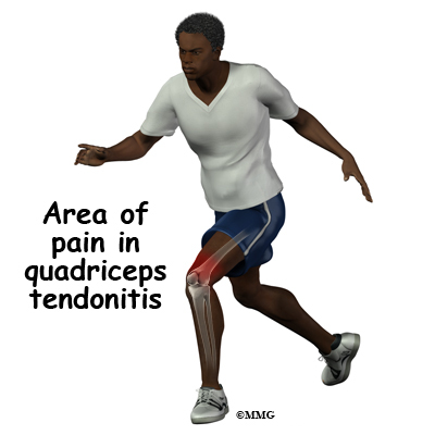 Quadriceps Tendonitis