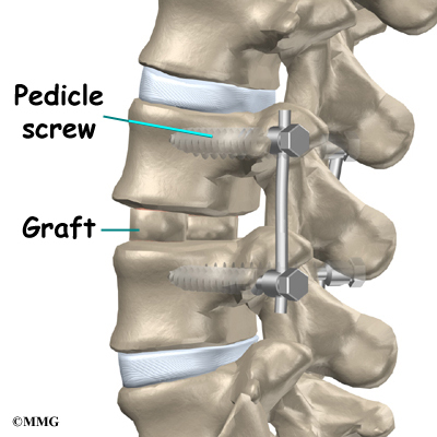 fusion lumbar anterior interbody hardware alif spine posterior graft procedure patient eorthopod instrumentation vertebrae