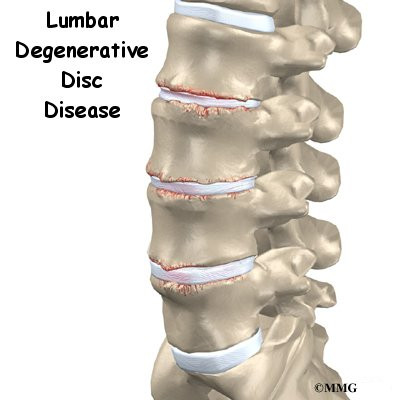 Lumbar Degenerative Disc Disease