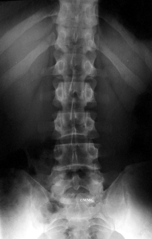 lumbar disc herniation rays muscle spine herniated lower does discs pain skin eorthopod diagnosing herniations cause doctor chiropractic tested reflexes