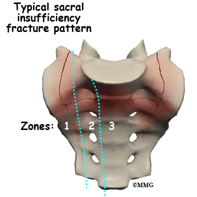 Sacral Insufficiency Fractures | eOrthopod.com