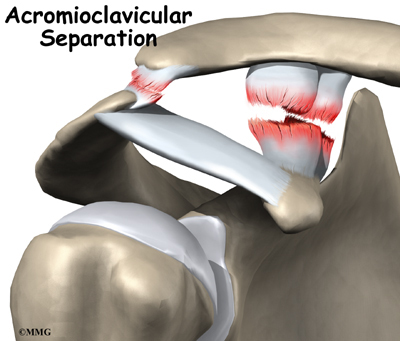 Acromioclavicular Joint Separation