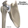 Artificial Joint Replacement of the Shoulder | eOrthopod.com