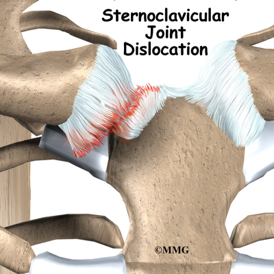 Sternoclavicular Joint Problems