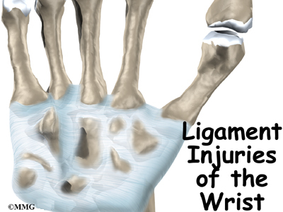 Wrist Ligament Injuries