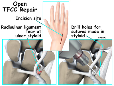 Triangular Fibrocartilage Complex Injuries